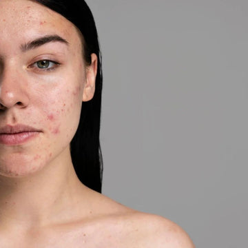 half of a woman's face with acne on it