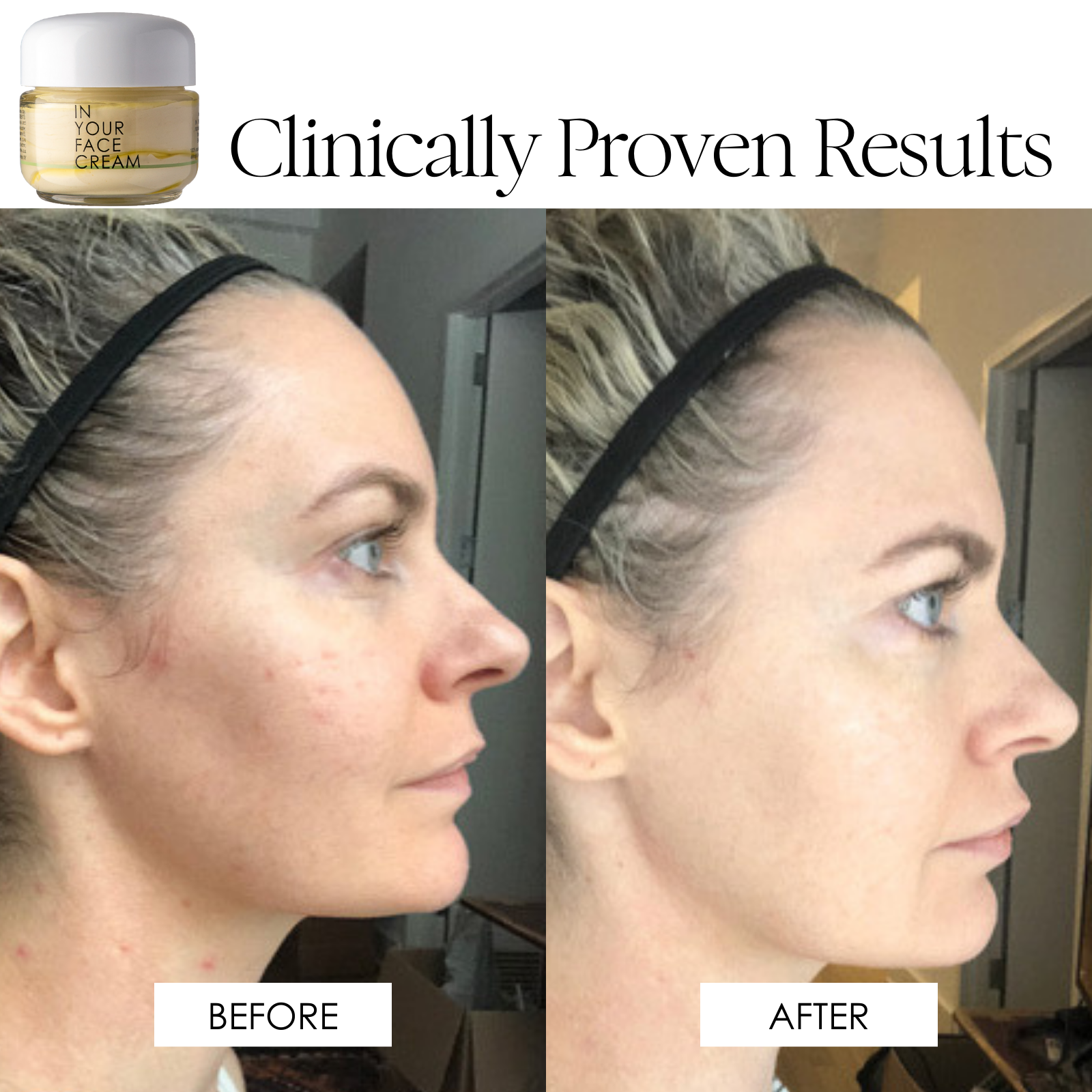 an image showing a before and after of a pretty blonde woman in her late 40's/early 50's, showing in the before her skin showing some hyperpigmentation and dullness. The image on the right saying "after", shows her skin looking brighter and more of an even skin tone. 