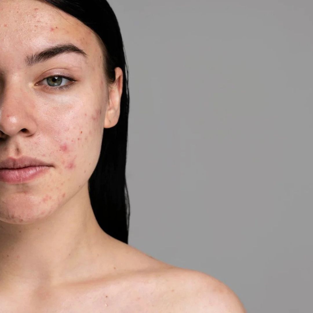 THE NATURAL WAY TO FADE ACNE SCARS