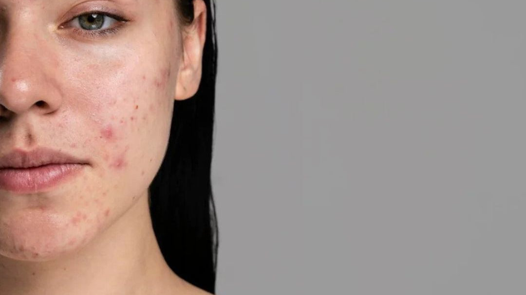 half of a woman's face with acne on it
