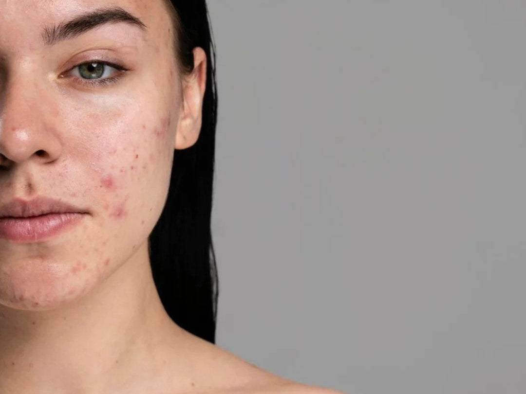 half of a woman's face with acne on it