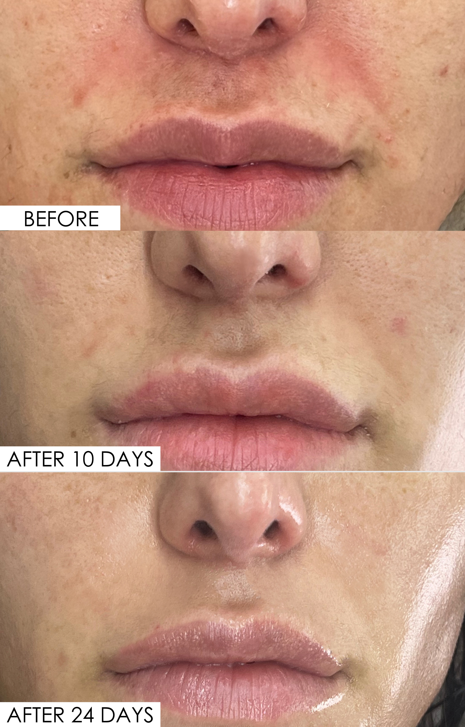 a before and after of a nose and mouth area on a person. The first image at the top says 'before' and shows redness and hyperpigmentation. Then an image saying 'after 10 days', showing less redness, then finally after 'after 24 days', showing a more even-looking skin tone, quite a difference from the 'before' shot. 