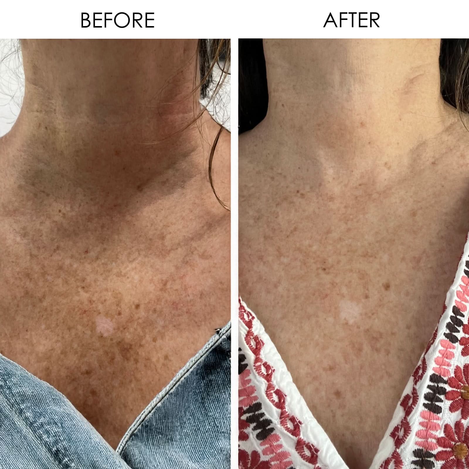 closeup of neck and décolletage before and after VITAMIN C PLUMPING SERUM