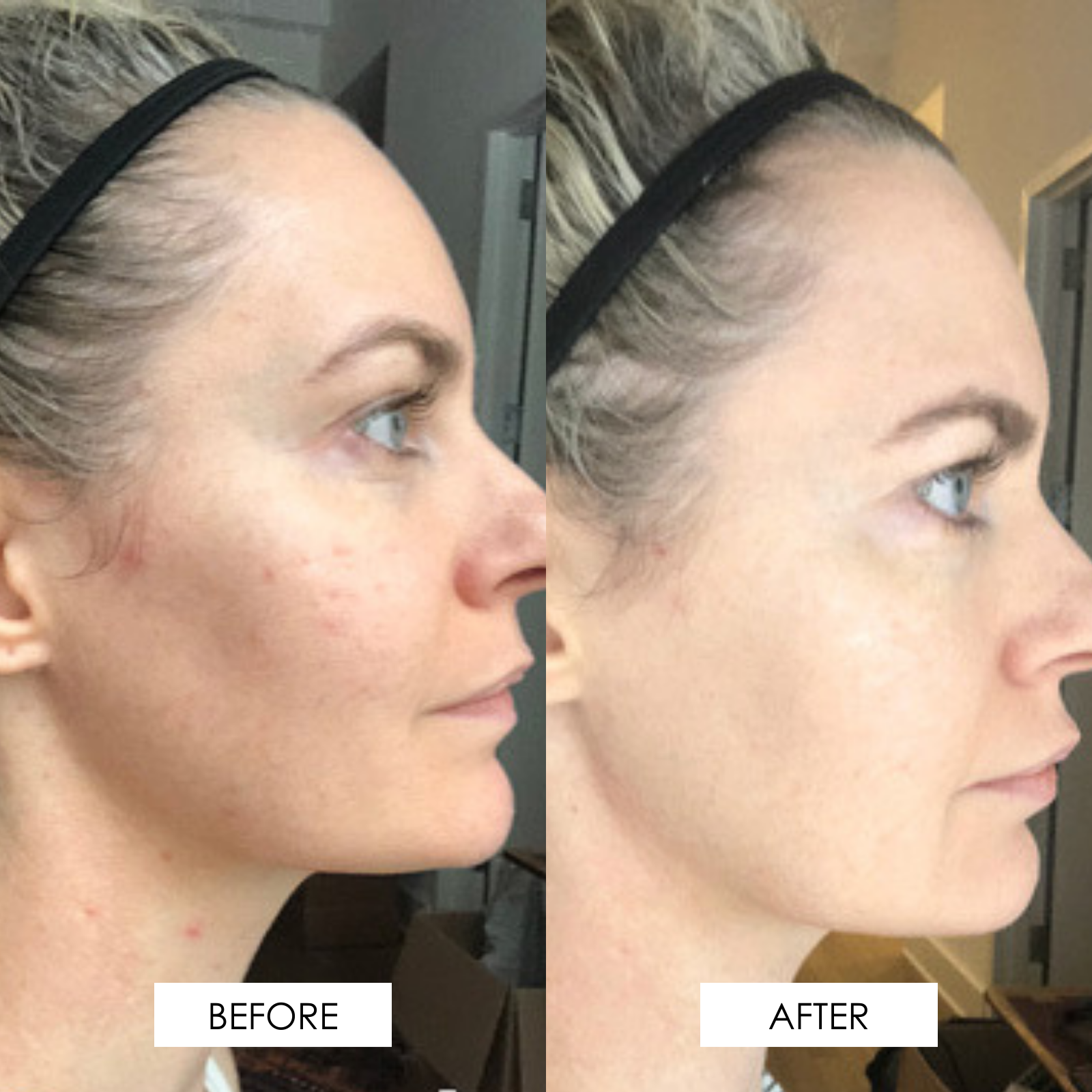 before and after of a woman using the CREAM