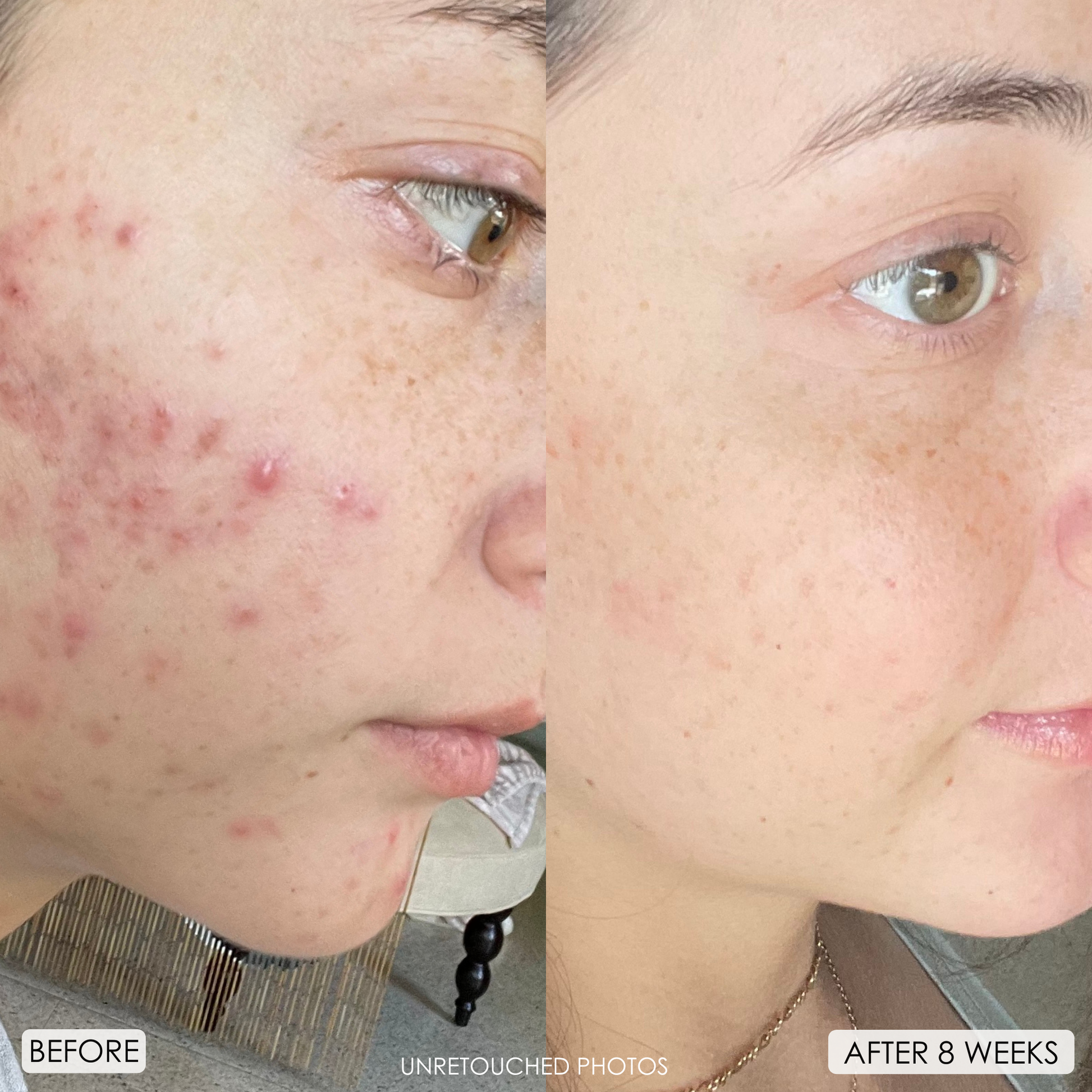 a before and after, showing a young woman with heavy, red acne on her cheeks in the 'before' and then after showing the acne looks like it dissapeared, and her skin looks brighter and more even.