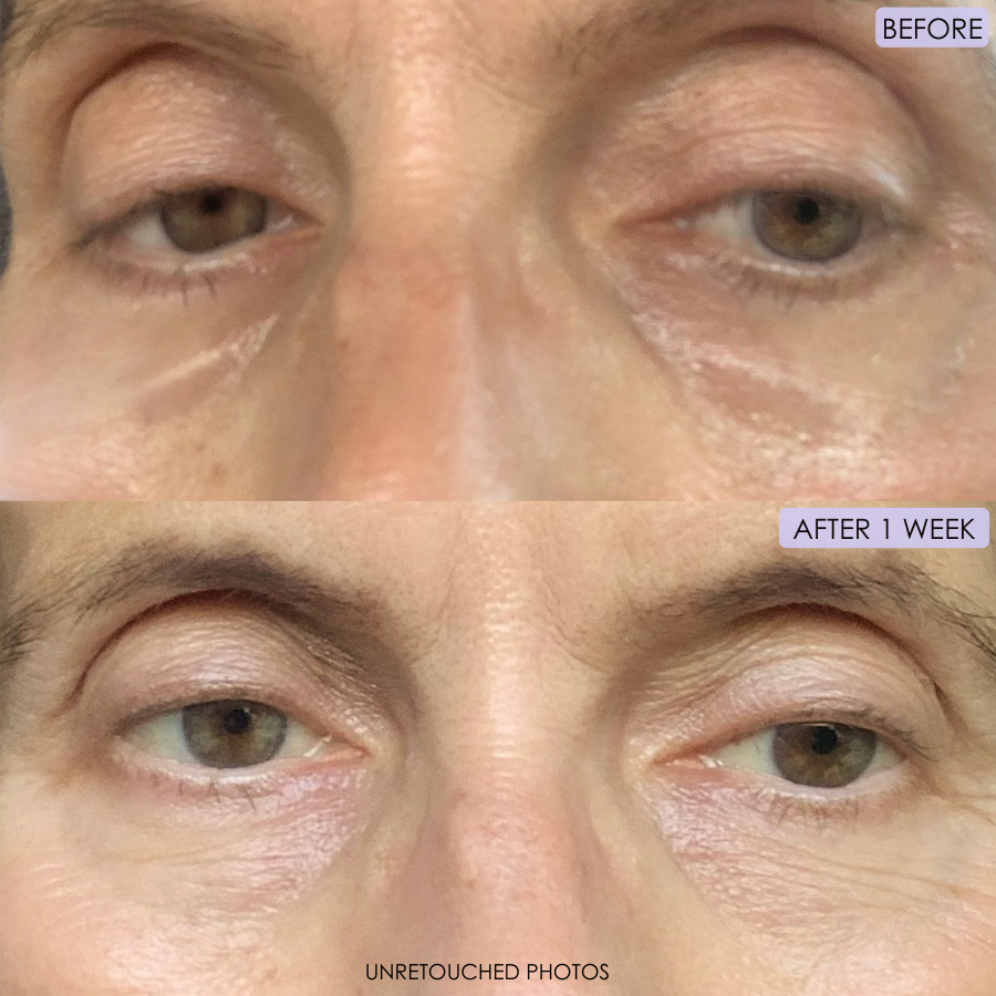 a before and after of a 50 year old woman, showing her eyes. The before shot shows more pronounced bags under the eyes and dark circles. In the after shot, it shows a more bright and smooth-looking undereye area.
